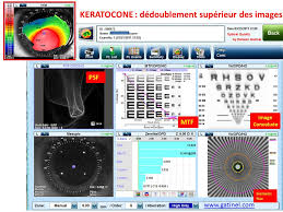 Pourquoi certaines personnes deviennent affreuses. Images Fantomes Vision Double Docteur Damien Gatinel