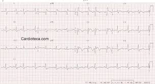 ¿cómo se produce el infarto agudo de miocardio? Curso Ecg Infarto Agudo De Miocardio Anterior Evolucionado Enfermedad Severa De 3 Vasos