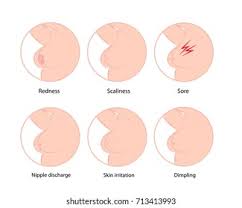 Breast cancer is the most. Suchen Sie Nach Early Symptoms Breast Cancer Vector Illustration Stockbildern In Hd Und Millionen Weiteren Lizenzfreien Stockfotos Illustrationen Und Vektorgrafiken In Der Shutterstock Kollektion Jeden Tag Werden Tausende Neue Hochwertige Bilder