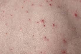 Image result for folliculitis symptoms