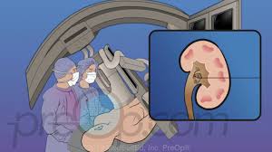 Kidney Stones Surgery Preop Patient Education Patient Engagement Youtube I know you want them lewd body pillows but there simply no market for stolen kidneys. kidney stones surgery preop patient education patient engagement