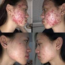 How do they know my needs? Treat Acne Fine Lines And More Curology Custom Skincare Start Your Free Trial
