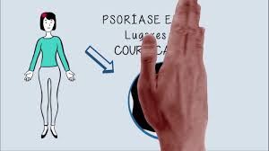 Índice de gravidade da psoríase ungueal modificado. Psoriase O Que E Tratamento E Tem Cura Minha Vida