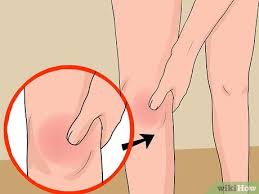 Kondisi ini ditandai dengan tempurung lutut yang bergeser ke lokasi yang tidak seharusnya tak asing lagi, osteoartritis sering kali menjadi penyebab nyeri lutut setelah usia 50 tahun. 4 Cara Untuk Merawat Lutut Yang Bengkak Wikihow