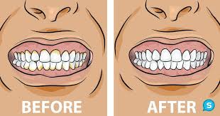 You should also periodically soak it in a cleaning solution similar to a denture cleanser. How To Treat And Remove Plaque