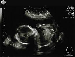 If your first ultrasound is earlier than seven weeks, the baby is often so small that it's hard to see with a traditional abdominal whether it's six weeks or later, you'll need to prepare for your first ultrasound appointment. Pregnancy 6 Week 19 20 Update Simply Designing With Ashley