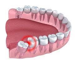 A Prosthesis Needed After Removing Wisdom Tooth Wisdom Teeth Tooth Extraction Aftercare Teeth