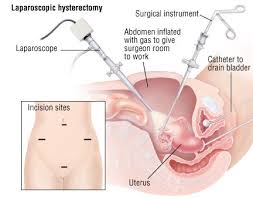 hysterectomy harvard health laparoscopic surgery hysterectomy laproscopic surgery