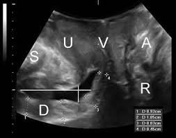 Getting an ultrasound may sound scary, but it's a simple, painless procedure. Pelvic Floor Ultrasound Springerlink