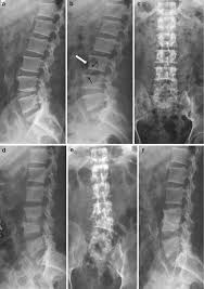Image result for Spinal Infection