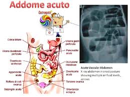 La peritonite acuta diffusa causa. Il Dolore Addominale Chirurgico L Addome Acuto