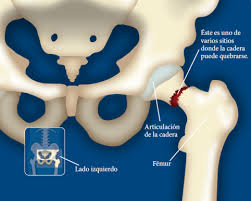 Controle El Dolor Por Una Fractura De Cadera Effective Health Care Ehc Program