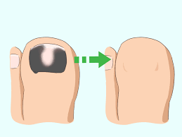 Zwarte schimmel onder de nagels of teennagels is een ernstige infectie die niet lichtvaardig moet worden genomen. Een Zwarte Teennagel Behandelen Wikihow