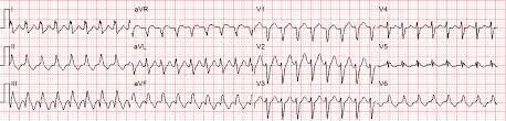 An umbrella term used to describe tachycardias. Svt With Aberrancy Or Ventricular Tachycardia Acls Medical Training