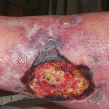 17, 2021 / subscribe 0. Recalcitrant Ulcer On The Lower Leg Mdedge Dermatology