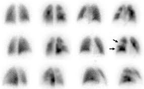 Image result for Ventilation Perfusion Scan