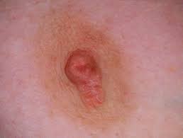 For babies with eczema, finding the best baby eczema cream is essential. Lactation And The Skin Dermnet Nz