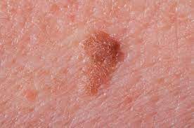Some types of skin cancer are more dangerous than others, but if you have a spot. Difference Between Age Spots And Cancer Age Spots Vs Cancer
