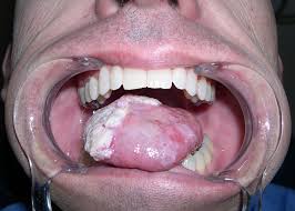 Image result for cancer of tongue