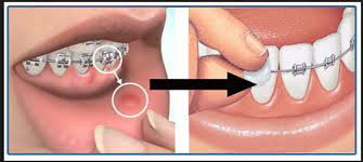 Robison Orthodontics Mesa Arizona Robison Orthodontics Mesa Az Cheeks And Lips Irrit Dental Braces Orthodontics Braces