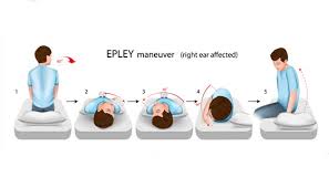 Image result for Canalith Repositioning Procedure