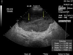 Can be performed ta (transabdominal) or tv (transvaginal) ct abdomen. Pelvic Ultrasound Showing A Complex Fluid Collection In The Pelvis Download Scientific Diagram