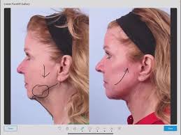 Lower Facelift, Deep Lane Facelift and Neck Lift Result with Dr. Sudeep Roy  Los Gatos, CA