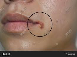Image result for Angular Stomatitis