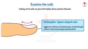 Kolinychia (( spoon nail))// dut to iron deficiency anemia (( may you see it in pregnant women usually due to increasing demand )) @medicin pic.twitter.com/lysw1hne7w. M Owais Shahid On Twitter Koilonychia Mainly Cause By Deficiency Of Iron Know About Your Nails Owaeyssdesign Meded Medicine Medicaleducatiom Awareness Https T Co Drwdcpqoxc