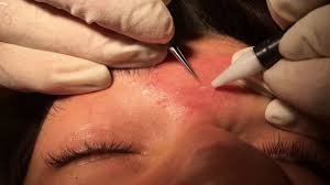 The electrolysis procedure involves inserting a tiny probe, or needle, into the opening of each hair follicle. Blend Electrolysis Hair Removal Youtube