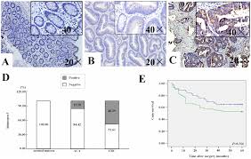 This is the case for orange, which represents the umbrella of blood cancers, as well as kidney cancer. Plos One Identification Of Kininogen 1 As A Serum Biomarker For The Early Detection Of Advanced Colorectal Adenoma And Colorectal Cancer