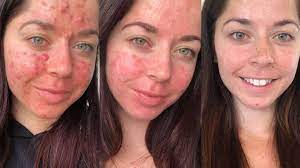 We did not find results for: Akne Entstellt Junge Frau Mit Dieser Methode Bekommt Sie Sie In Den Griff Gesundheit