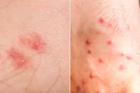Image result for flea bites