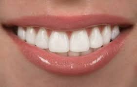 Blue cross blue shield (bcbs) is one of the nation's largest health insurance providers. Does My Dental Insurance Cover Cosmetic Dentistry