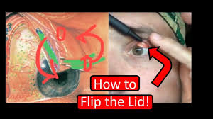 Maybe you would like to learn more about one of these? Flipping The Eyelid Made Easy Youtube