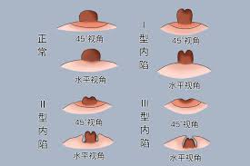 乳头内陷的图片