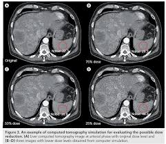 Functional imaging can thus be performed rapidly, with the least possible radiation and contrast dose. Radiation Dose Reduction In Computed Tomography Techniques And Future Perspective