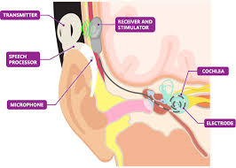 Check spelling or type a new query. Cochlear Implants Chad Ruffin Md
