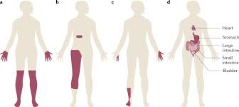 Diabetic Neuropathy Nature Reviews Disease Primers