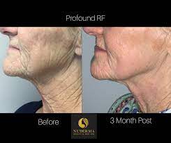 Maybe you would like to learn more about one of these? Sharing This Fantastic Before Nuderma Health Med Spa Facebook