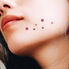Check spelling or type a new query. How To Get Rid Of Stress Acne Glamour