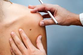 If you've received a diagnosis, here are some things you need to know about the condition. Don T Scratch That Mole Scientists Are Learning More About Inflammation And Cancer Memorial Sloan Kettering Cancer Center