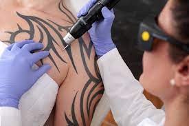 Malpractice insurance for laser tattoo removal clinics is professional coverage for the individuals performing the procedure. Tattoo Removal Insurance Get A Free Quote Park Insurance