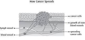 Doctors often use diagnostic tests to determine a cancer's stage. How Cancer Starts Grows And Spreads Canadian Cancer Society