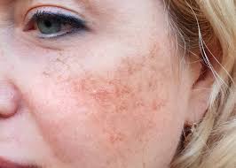 Image result for Melasma