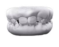 The varying tiers reflect the number of invisalign ® aligner treatments prescribed by a doctor, ranging from fewest (bronze) to most (diamond plus). Invisalign Treatment Invisalign Clear Aligners