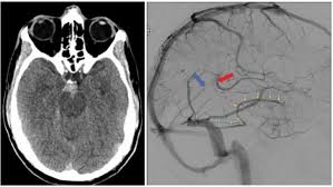 L'emorragia subaracnoidea (esa) è una grave condizione clinica in neurologia e neurochirurgia può essere causata da rottura di un aneurisma cerebrale, da fattori traumatici o, a volte, restare. Emorragia Perimesencefalica Sine Materia Associata Ad Anomalie Del Drenaggio Venoso Cerebrale Medicitalia It