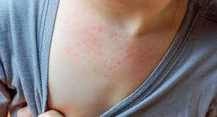 Roseola O Exantema Subito Que Es Y Causas Bebes Y Ninos
