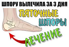 боль в пятке при ходьбе как лечить в домашних условиях Shporu Vylechila Za 3 Dnya Bol V Pyatke Pyatochnaya Shpora Medicina