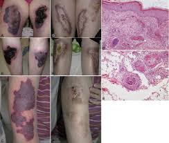 It is sometimes associated with symmetrical peripheral gangrene (tissue death affecting hands and feet). Purpura Fulminans In A Patient With Rheumatoid Arthritis Html Acta Dermato Venereologica